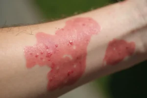 AZS Diagnostyka – Objawy, Przyczyny i Metody Leczenia