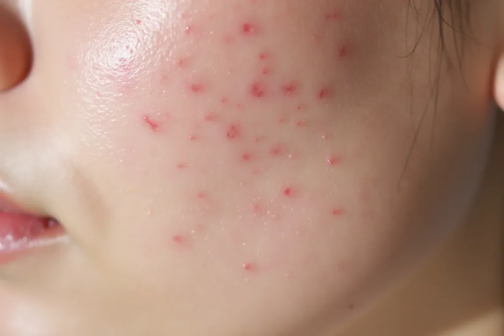 DMSO na blizny potrądzikowe – Działanie i Zastosowanie